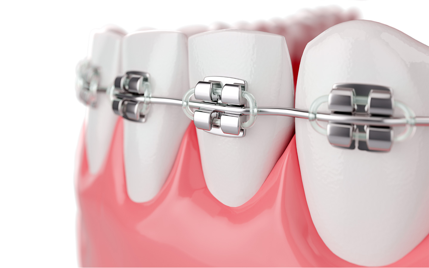 Festsitzende Zahnspange bestehend aus Brackets und Drähten