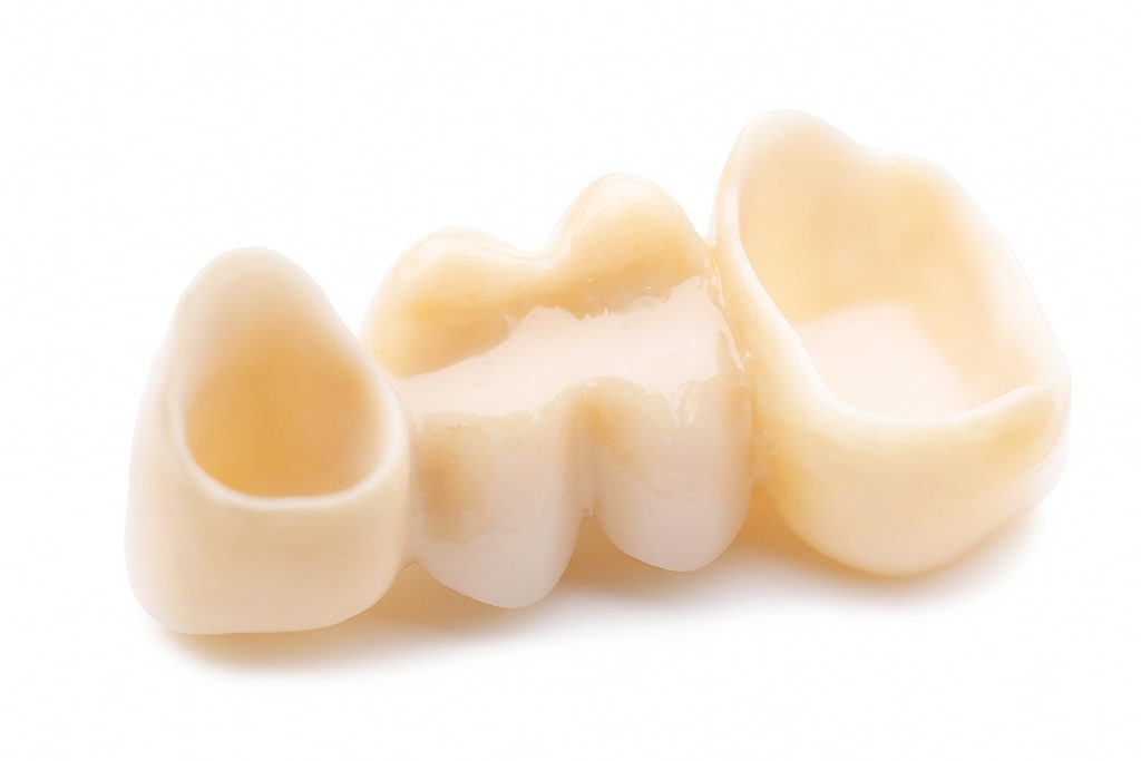 Vollkeramische Zahnbrücke für eine perfekte Zahnästhetik und uneingeschränkte Kaufunktion in Wien Floridsdorf