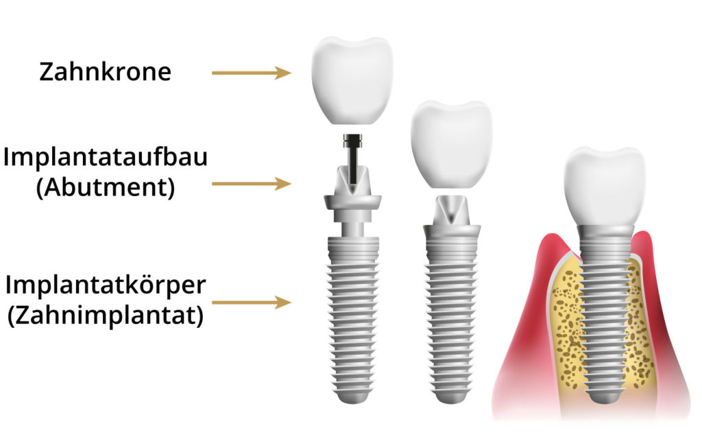 Grafische Darstellung der Implantat-Bestandteile und des Behandlungsablaufs in der Zahnpraxis Donaufeld