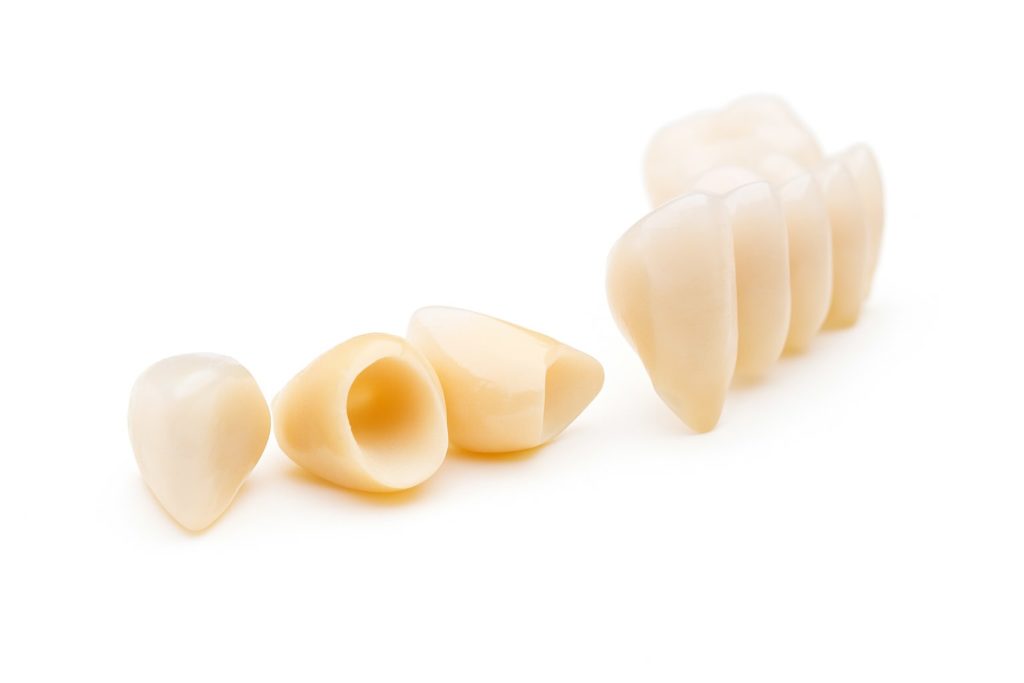 Hochwertige metallfreie Zahnkronen und Veneers für ein strahlendes Lächeln in der Zahnpraxis Donaufeld